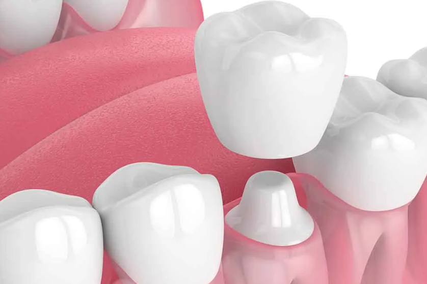 Esthetic Crown