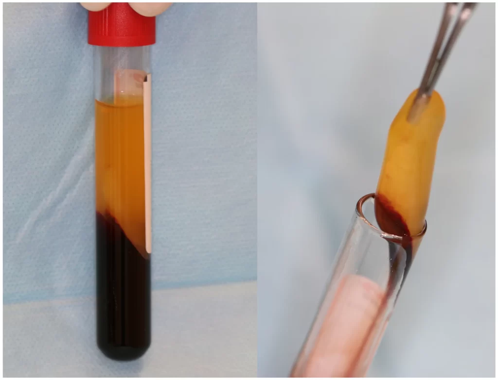 Platelet Rich