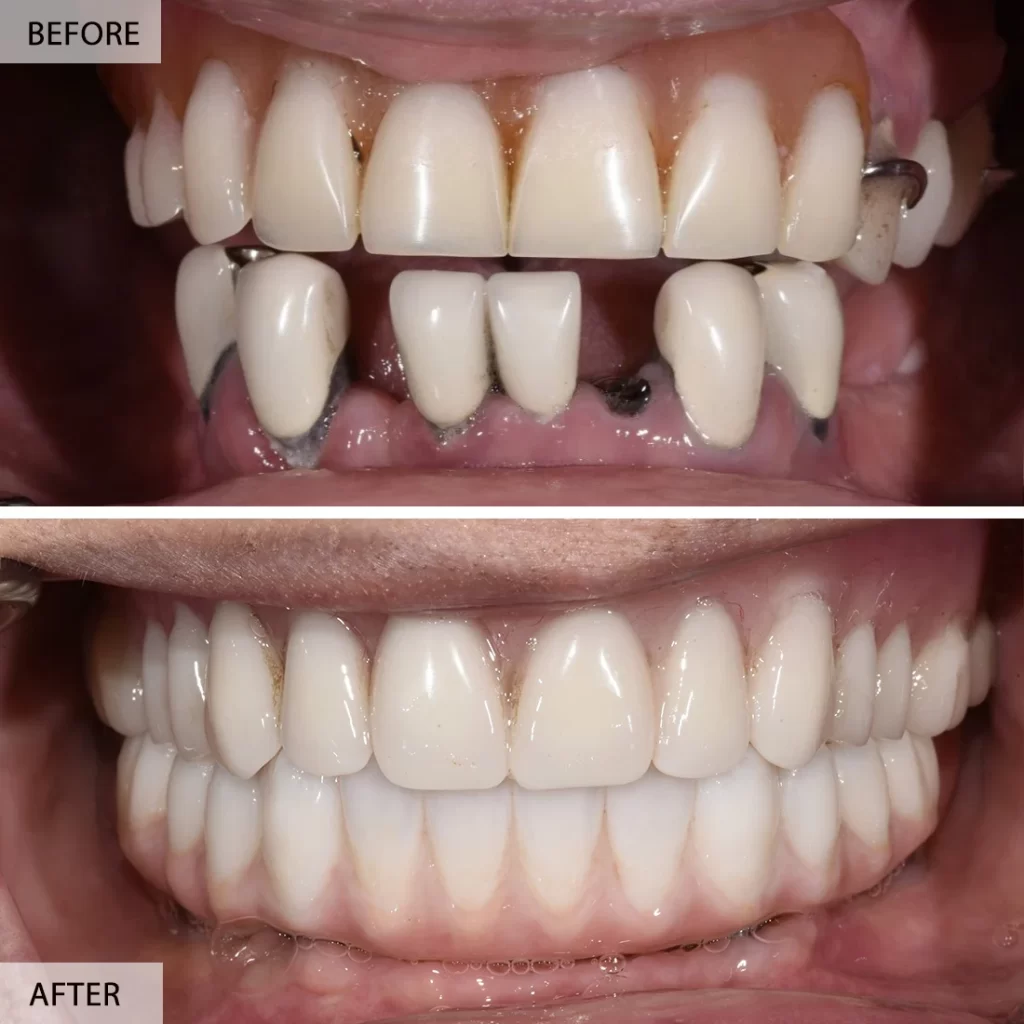 All On 4 Before After 1